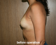 plastic-surgery-breast-augmentation